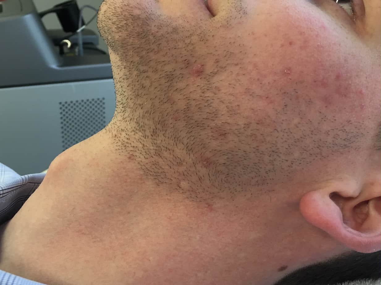 client after beardscaping close up of man's neck after laser hair removal with no hair or blemishes