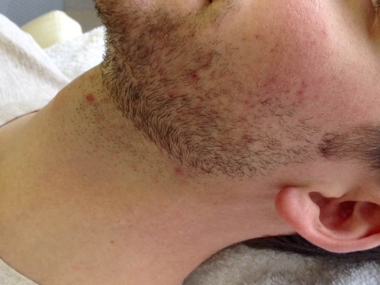 client before beardscaping close up of man's neck with stubble and irritation before laser hair removal