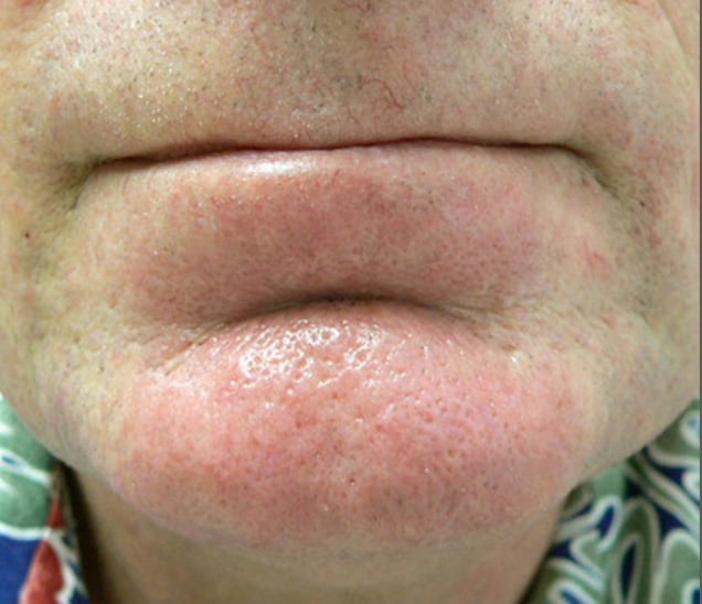 man's chin after IPL for broken capillaries