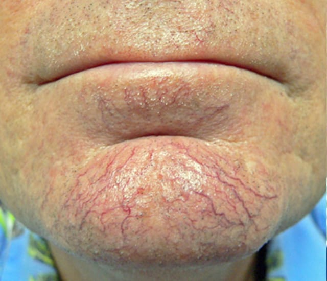 man's chin with spider veins before IPL treatment