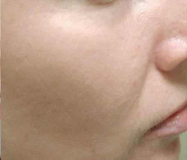 photofacial after 3tx close up of cheek with no freckles after photofacial in McLean VA