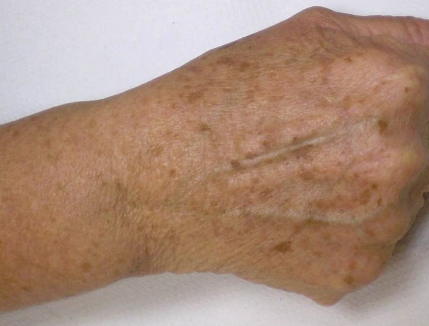 hand with age spots before IPL treatment