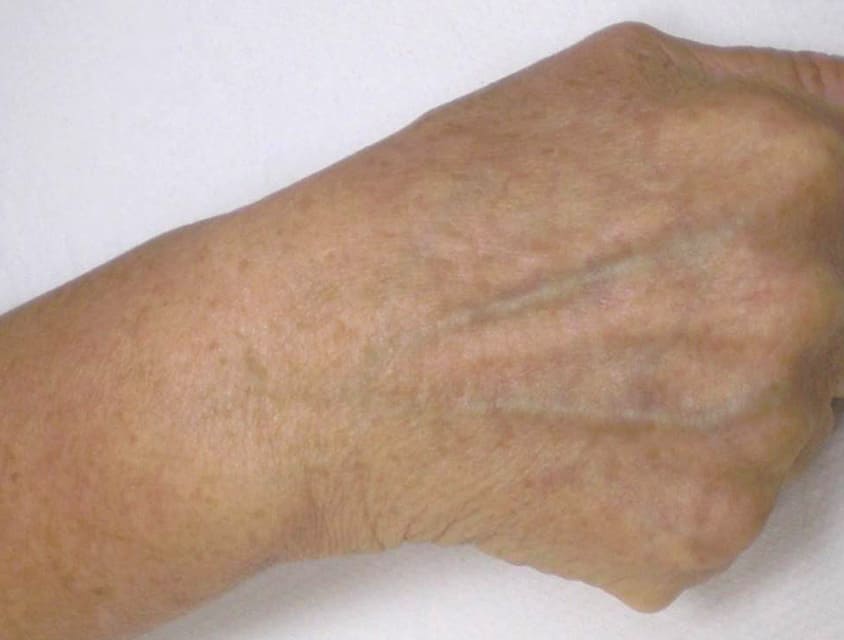 hand with no age spots following IPL treatment