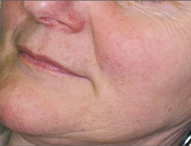 close up of woman's cheek showing results of IPL rosacea treatment