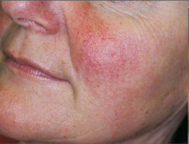 close up of woman's cheek showing rosacea before IPL in Northern VA