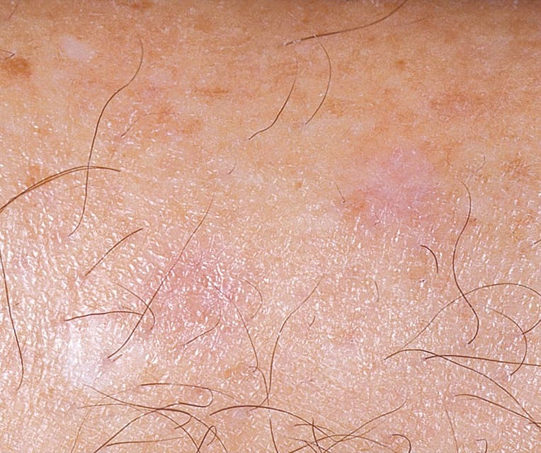 close up of skin after freckle removal