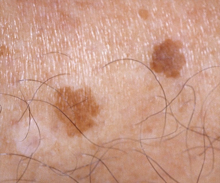 close up of skin with age spots