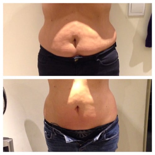 before and after showing much slimmer abdomen after cryolipolysis treatment
