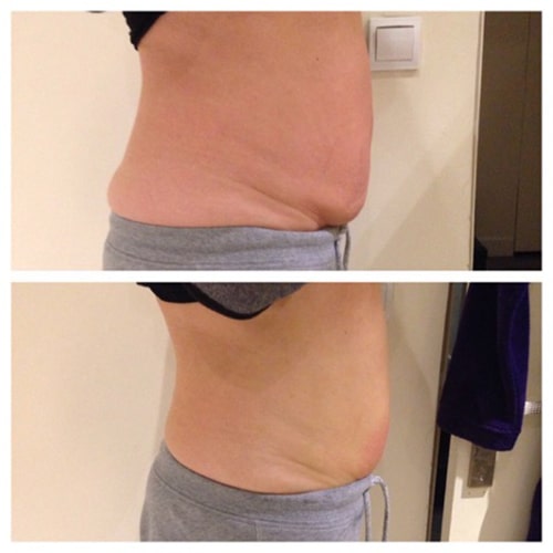 before and after showing slimmer female abdomen after cryoskin treatment