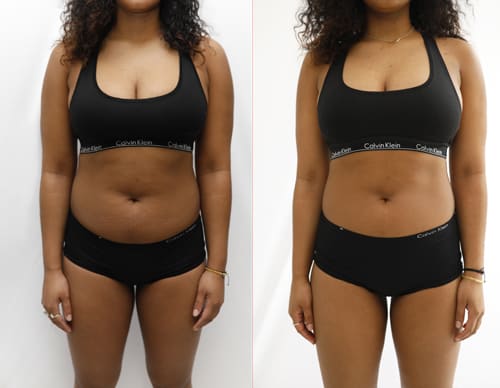 before and after showing slimmer abdomen after cryoskin treatment