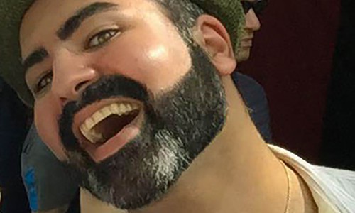 man's face and neck showing groomed beard from laser hair removal