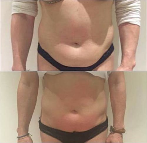 before and after body contouring on abdomen showing more fat before than after