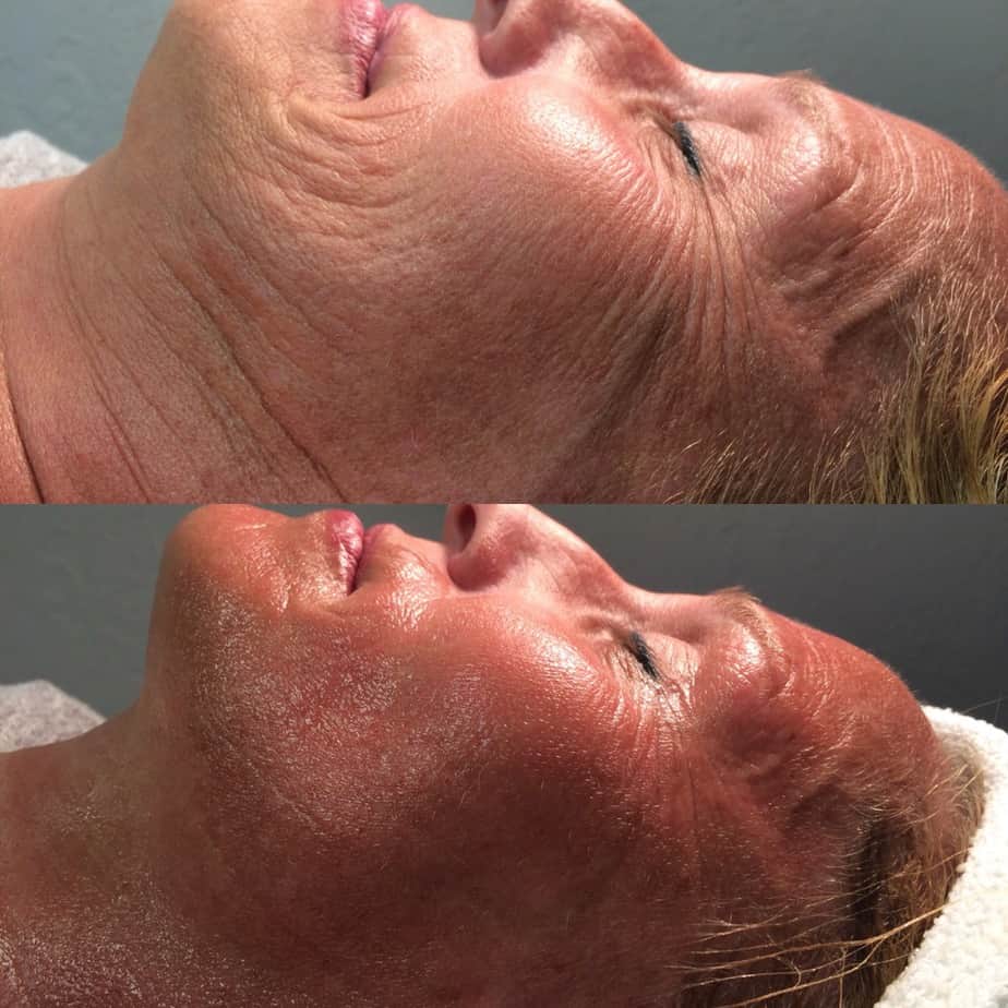 Facial Side- Before & After