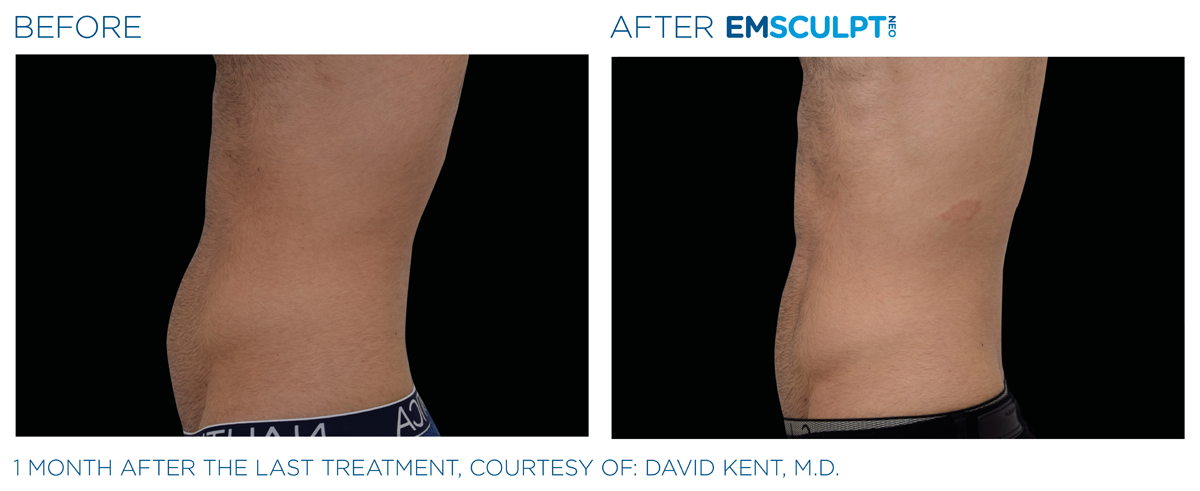 Emsculpt_neo_PIC_Ba-card-male-abdomen-021_ENUS100 EmSculpt NEO near me before & after abdomen